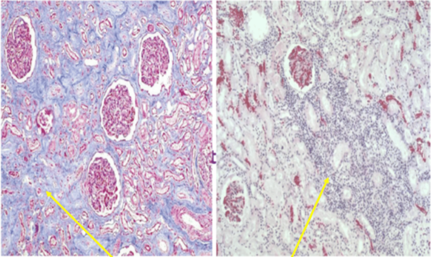 <p>Stain for collagen (blue) showing fibrosis</p><p>Lymphocytes &amp; plasma cells present</p>