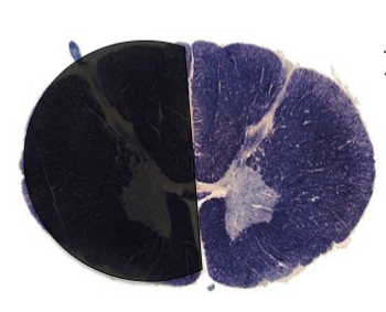 <p>a lesion here would cause…?</p>