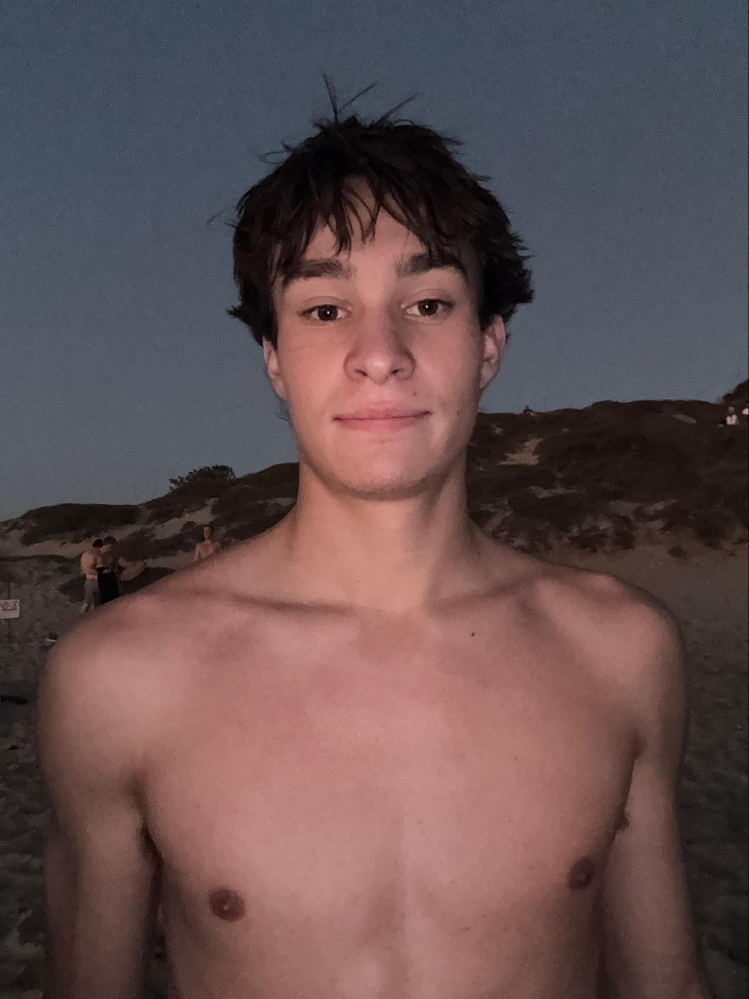 <p>Scar from snowmobile crash</p>