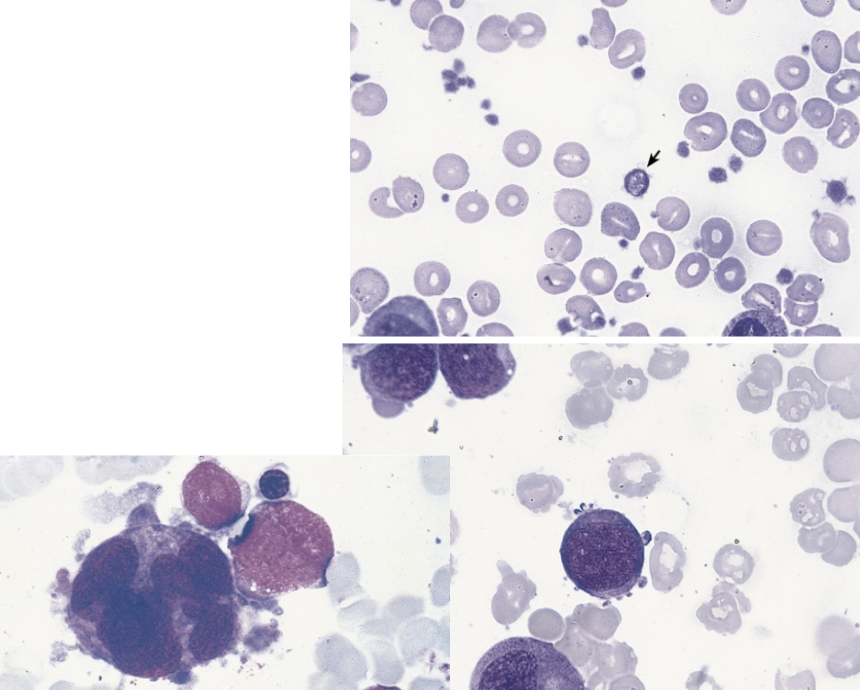 <p>these morphological abnormalities of the peripheral blood (top image) and BM (bottom 2 images) are characteristic of ____.</p>