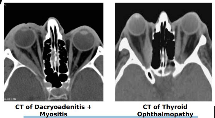 <ol><li><p>On CT scan, the tendons &amp; extraocular muscles are enlarged in idiopathic orbital inflammation. In thyroid ophthalmopathy, only the muscle belly is enlarged (coke bottle)</p></li></ol><p></p><p></p>