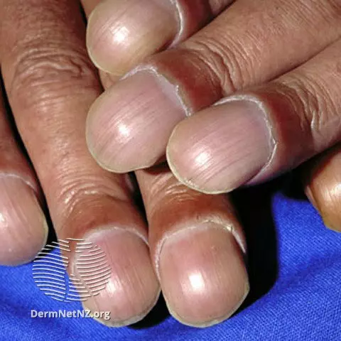 <p><span>abnormality where the ends of the fingers and toes enlarge and the nails curve</span></p>