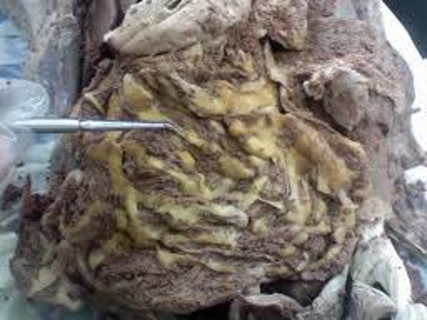 <p>a fatty sheet that hangs like an apron over the stomach area</p>