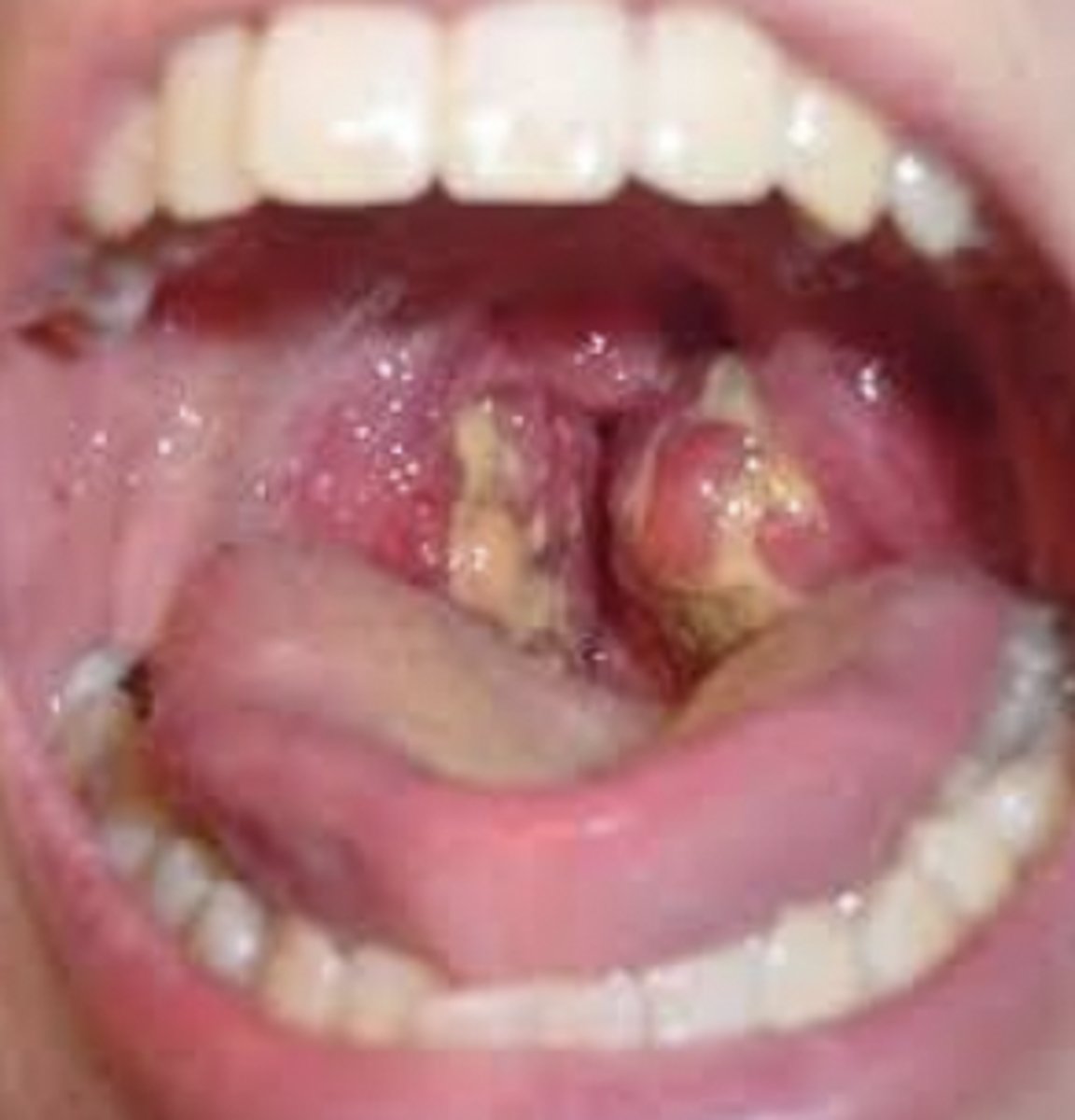<p>Exudate that develops on mucous membrane surfaces and are composed of necrotic cells</p>