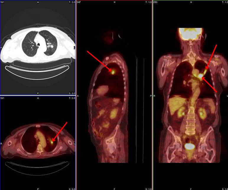 <p><span>What are <strong>solitary pulmonary nodules</strong>?</span></p>