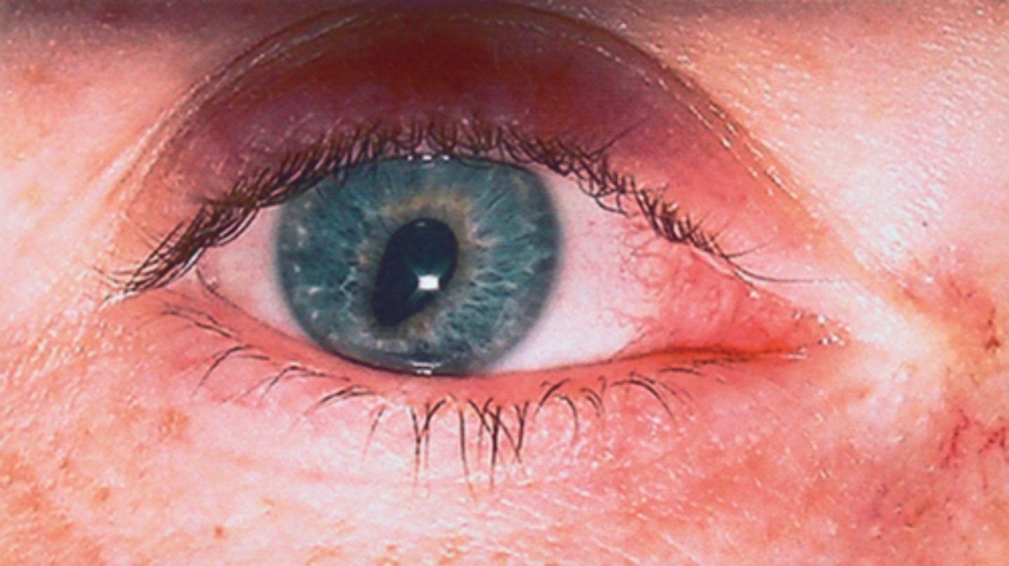 <p>What 1/3 etiology with the nerve causing a large pupil is shown here?</p>