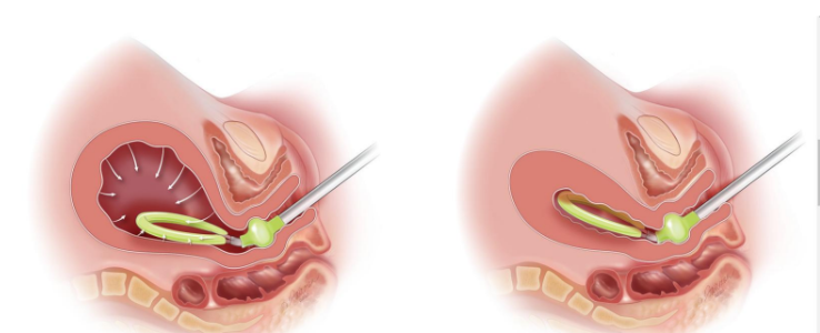 <p>is a flexible drainage device designed to control uterine bleeding by providing suction and creating negative pressure which collapses the uterus </p><p>made by engineering students</p>