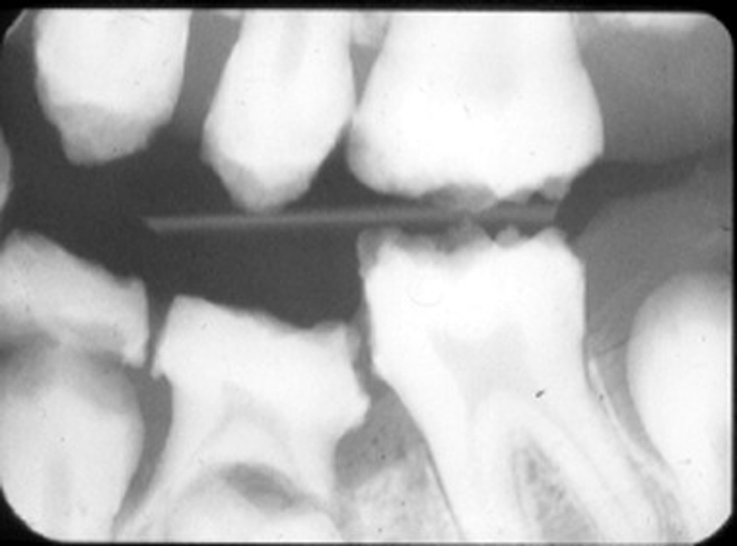 <p>- smaller than normal teeth</p><p>- yellow or brown discoloration</p><p>- teeth prone to damage, breakage</p><p>- sensitive teeth</p><p>- open bite malocclusion</p><p>- minimal to no enamel visible radiographically</p>