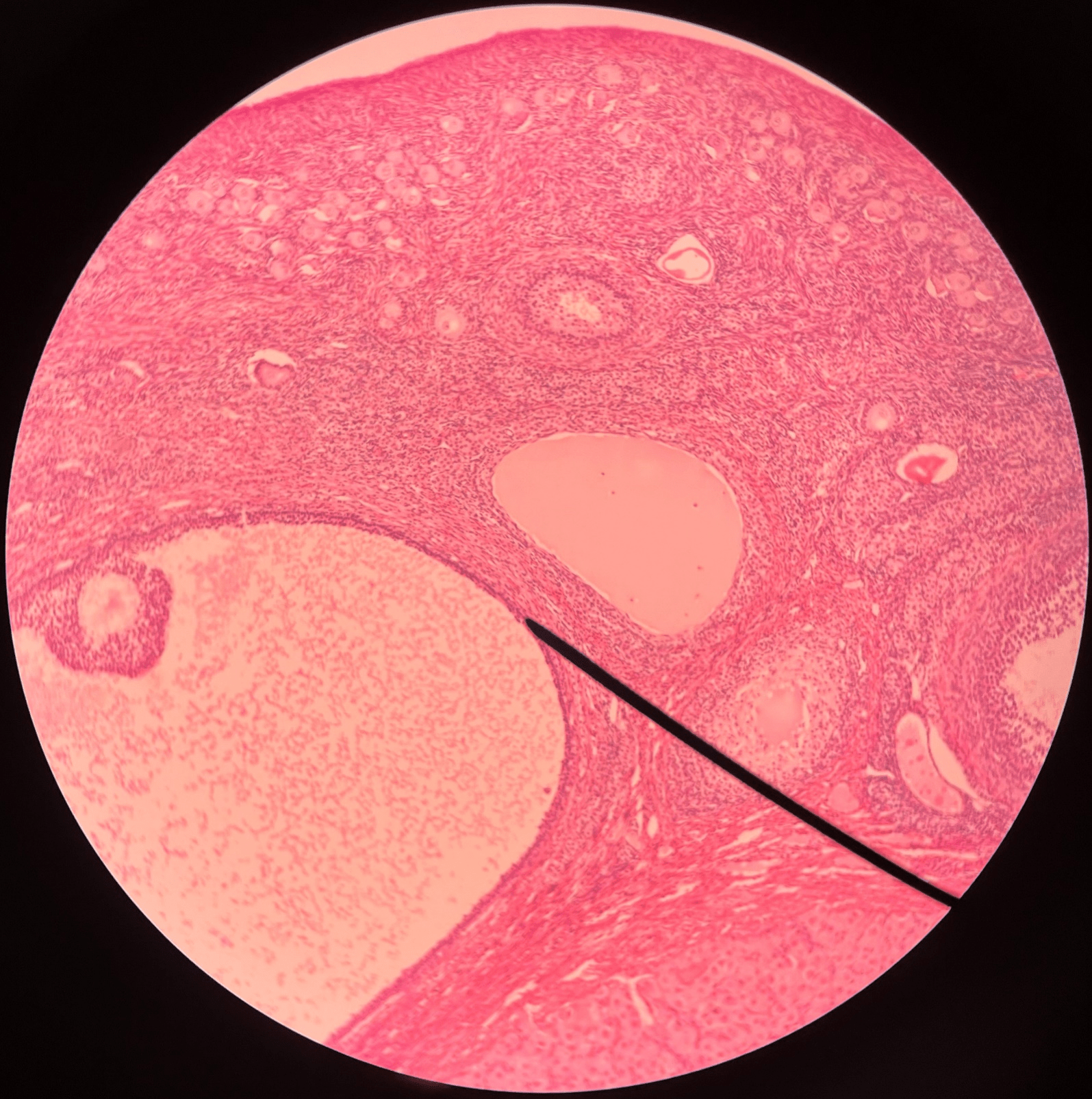 • Slide histology of the ovary.

• Appears significantly larger than a secondary follicle.

• Contains a large antrum and a corona radiata surrounding the oocyte.

• Also known as a tertiary or mature follicle.