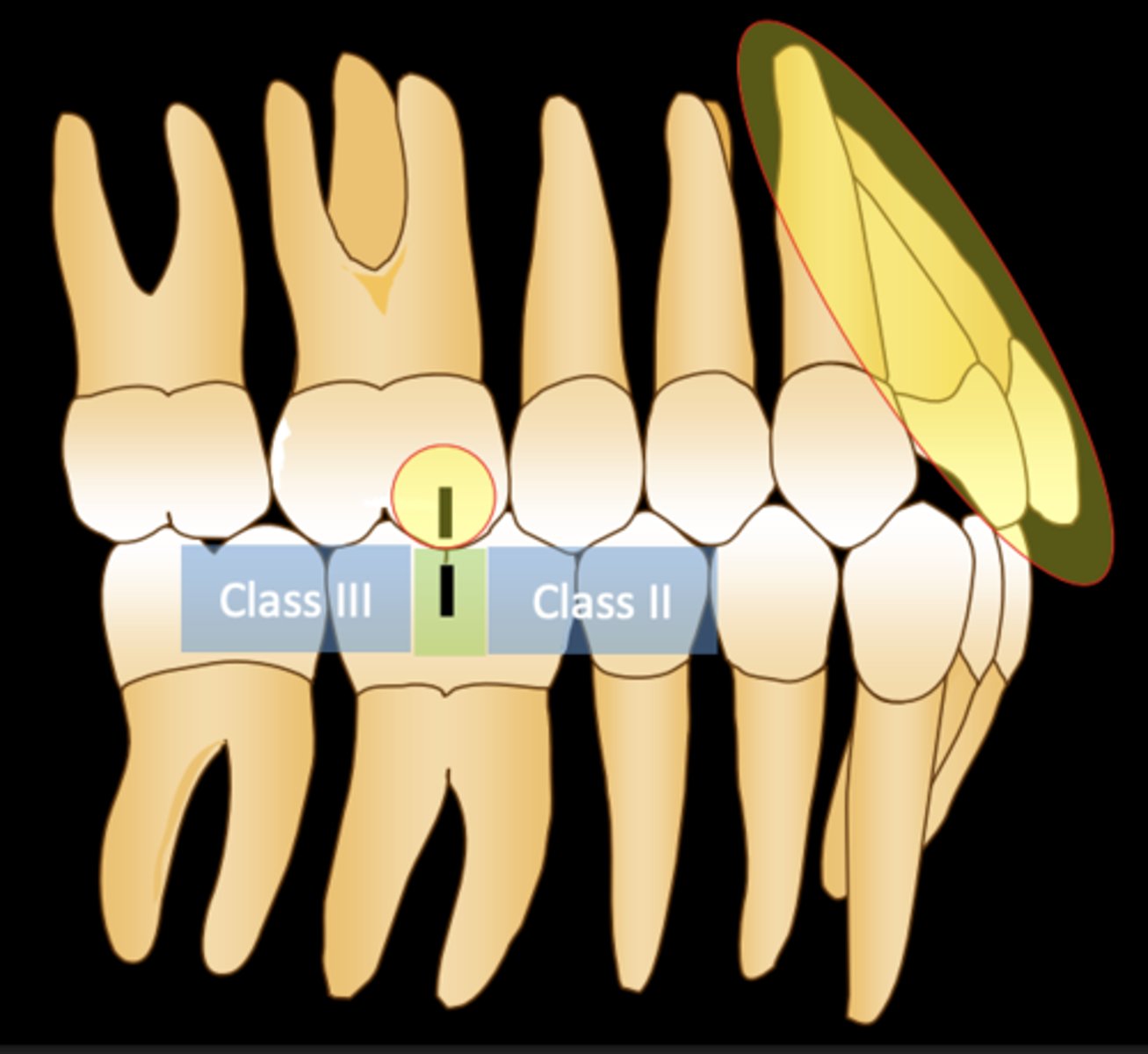 <p>- Class I molar occlusion</p><p>- Any maxillary incisor inclination</p><p>- Any amount of central incisor overject</p>