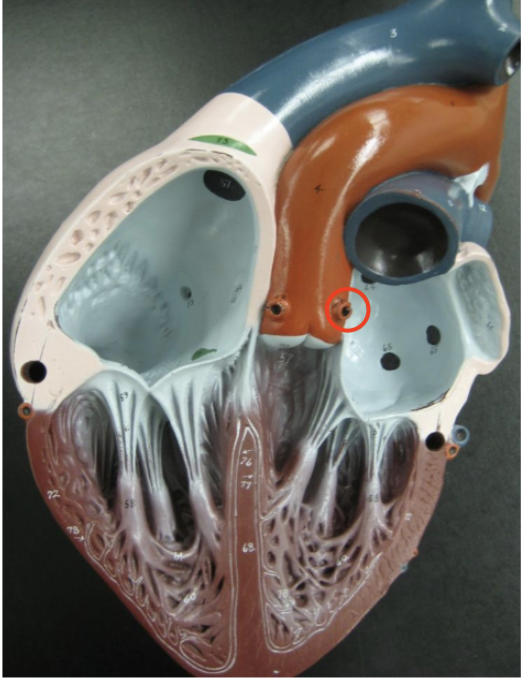 <p>potruding hole at the bottom left of the aorta</p>