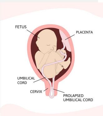 <p><strong>Cord Prolapse: Background</strong></p><p>-When the umbilical cord __________ through the ______ before the baby </p><p>-Risks → fetal _____________, premature infants, multiparous women, ____ umbilical cord, polyhydramnios, unengaged presenting part, and ______ of membranes at high fetal station</p>