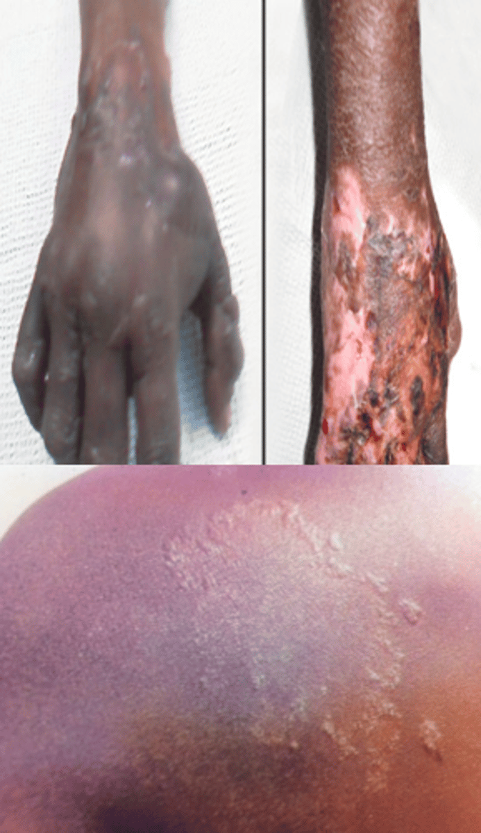 <p>95% of humans immune, common with people who work/eat armadillos, wil take millennia to get rid of, reprograms liver of armadillo and causes liver to regrow</p><p>is a treatment</p>