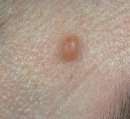 <p>is this a macule, papule, nodule, or lobule </p>