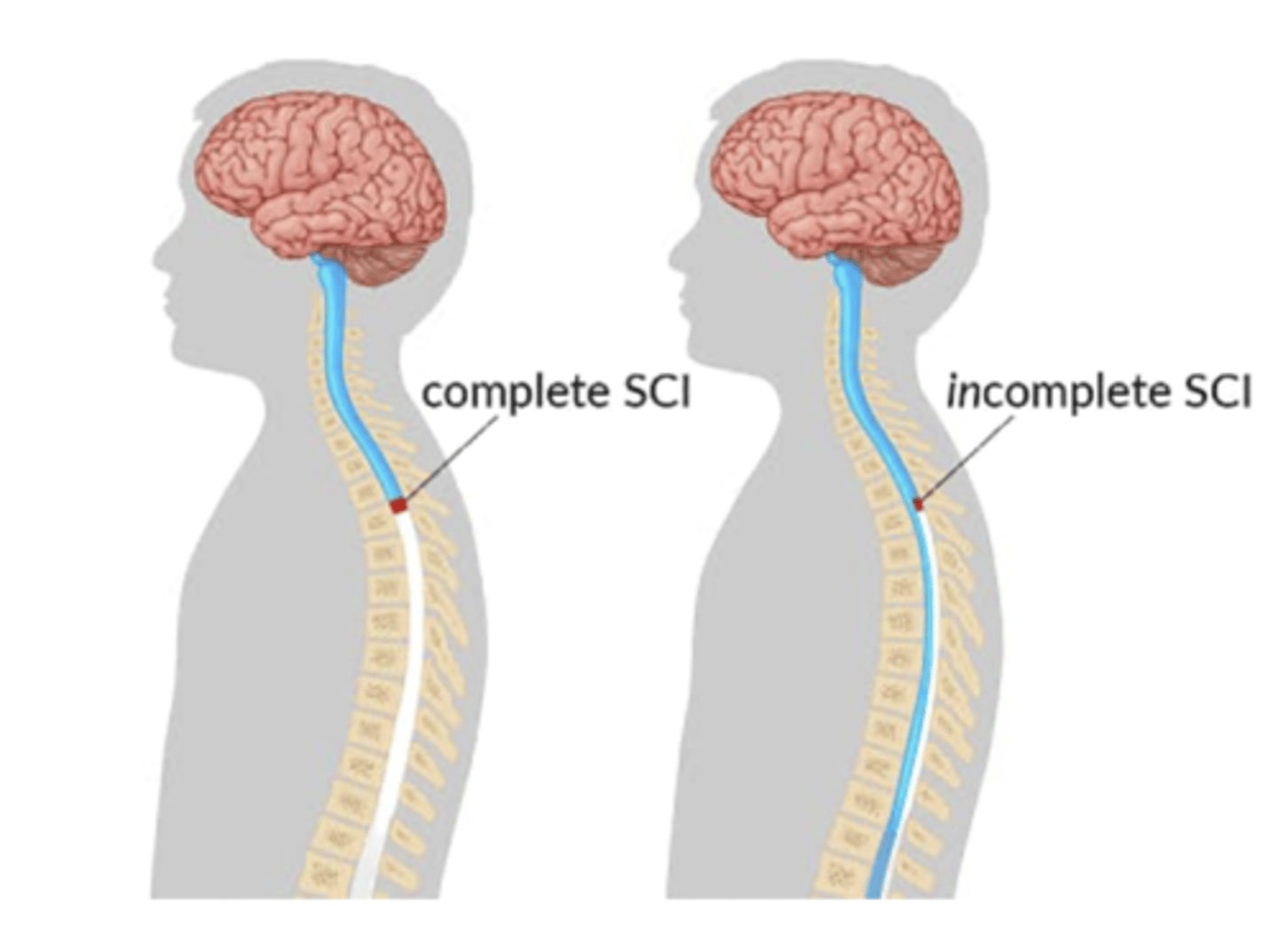 <p>- only peripheral rim of spinal cord is spared, so sacral segments remain intact</p><p>- retains sacral S4-S5 sensation, voluntary anal control, bladder and bowel function, possibly toe movement</p>