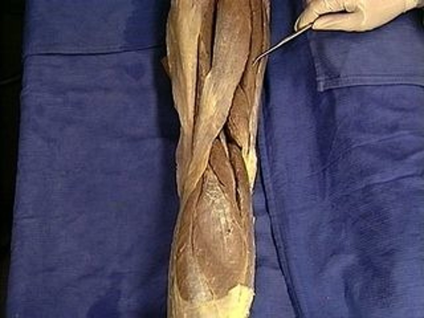 <p>Description: Inside of leg, next to Biceps Femoris</p>