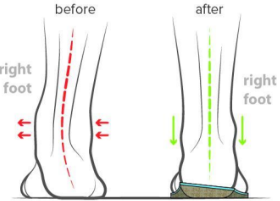 <p>Name this orthosis. Uses?</p>