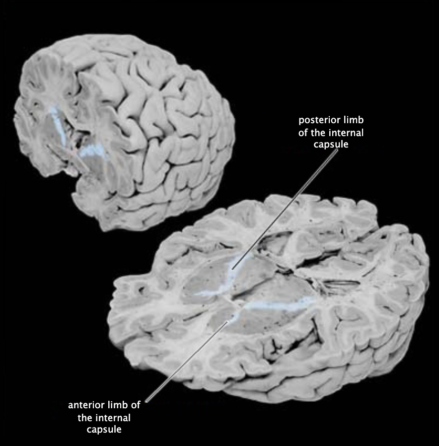 <p>Internal capsule, posterior limb</p>