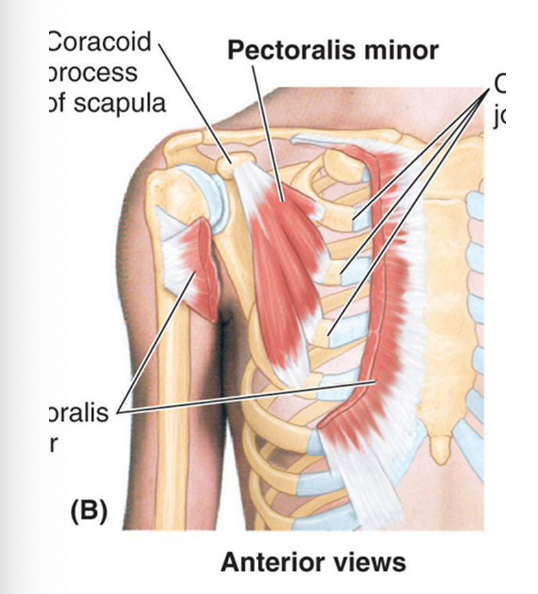 <p>Overcontraction of the pectoralis minor.</p><p>(Causes impingement on cords of brachial plexus and axillary blood vessels as they travel b/w coracoid process and rib cage)</p>