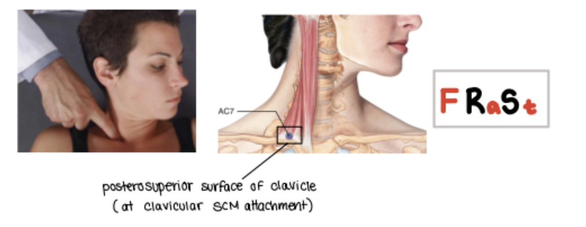 <p>Go on top of clavicle medially.</p><p>F STAR</p>