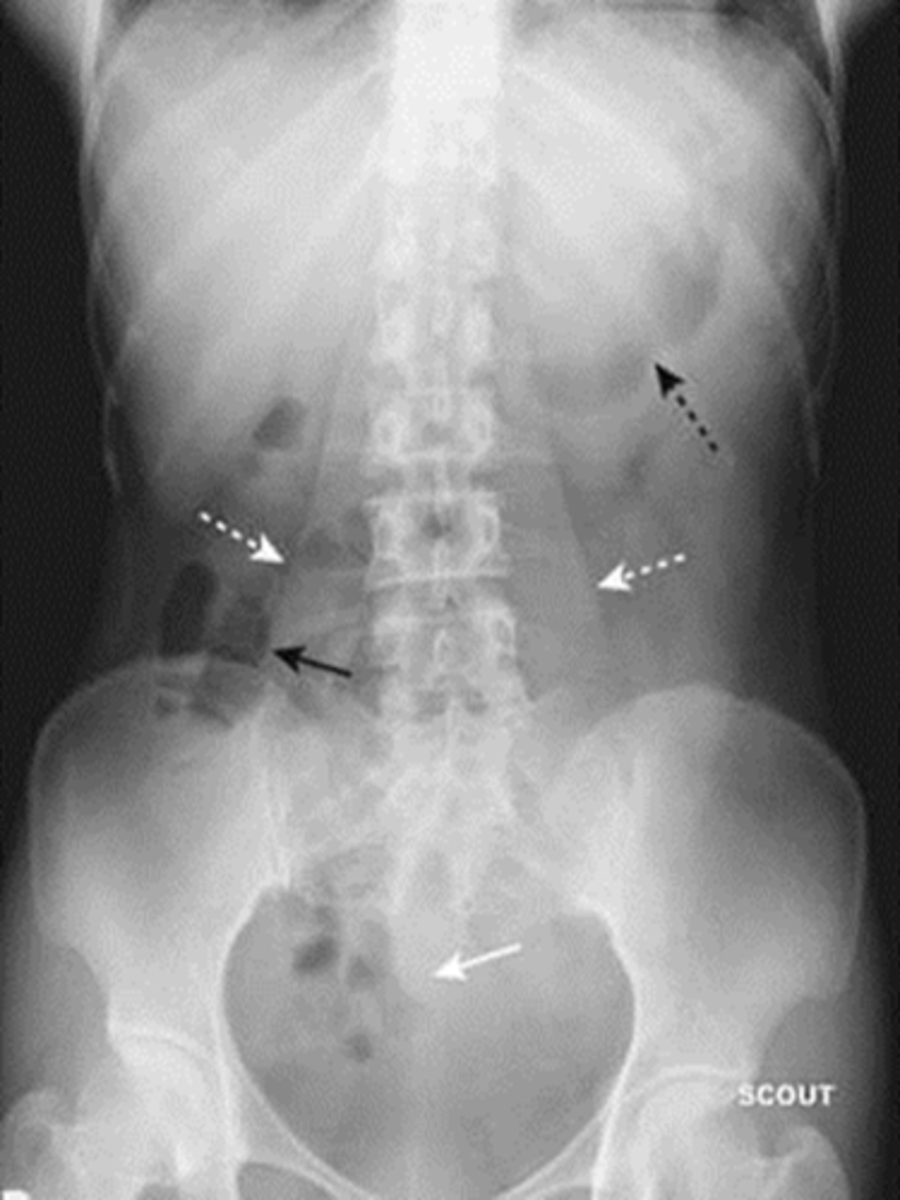 <p>What are four things to look for in a normal abdomen?</p>