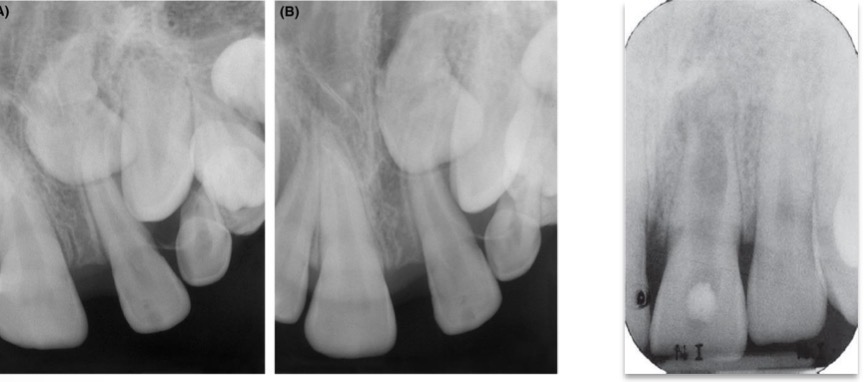 <p>Sharp curve in root suggest trauma or bony interference during root formation&nbsp;</p>