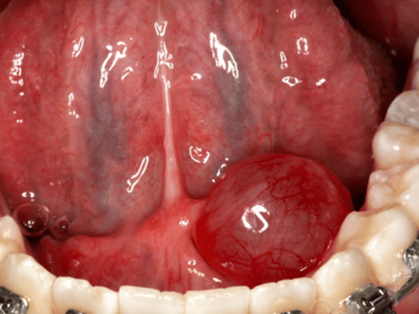 <p>patient presents with a dome-shaped fluctuant vesicle that looks bluish in color on the floor of the mouth. What is the diagnosis?</p>