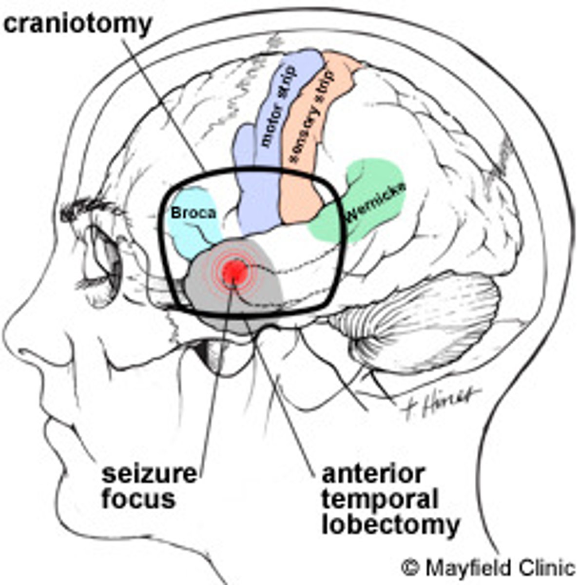 <p>(A) Tissue Removal</p><p>Tim will not be able to hear if you remove his temporal lobe.</p>