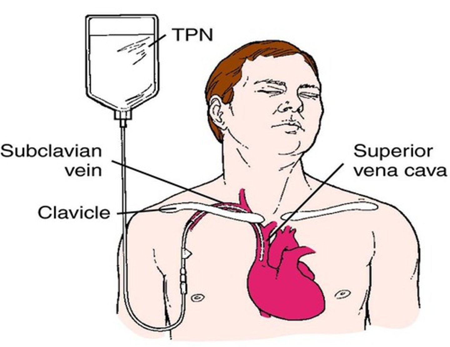 <p>Intravenous administration of nutrients.</p>