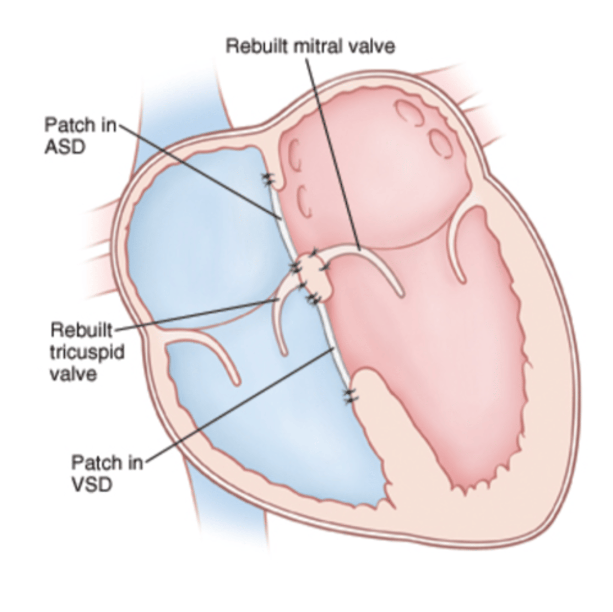 <p>surgical repair within first 6 months</p><p>- earlier if down syndrome</p><p>monitor for heart block post op</p>