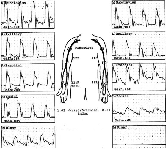 <p>Considering segmental blood pressure report, which side is abnormal? </p>