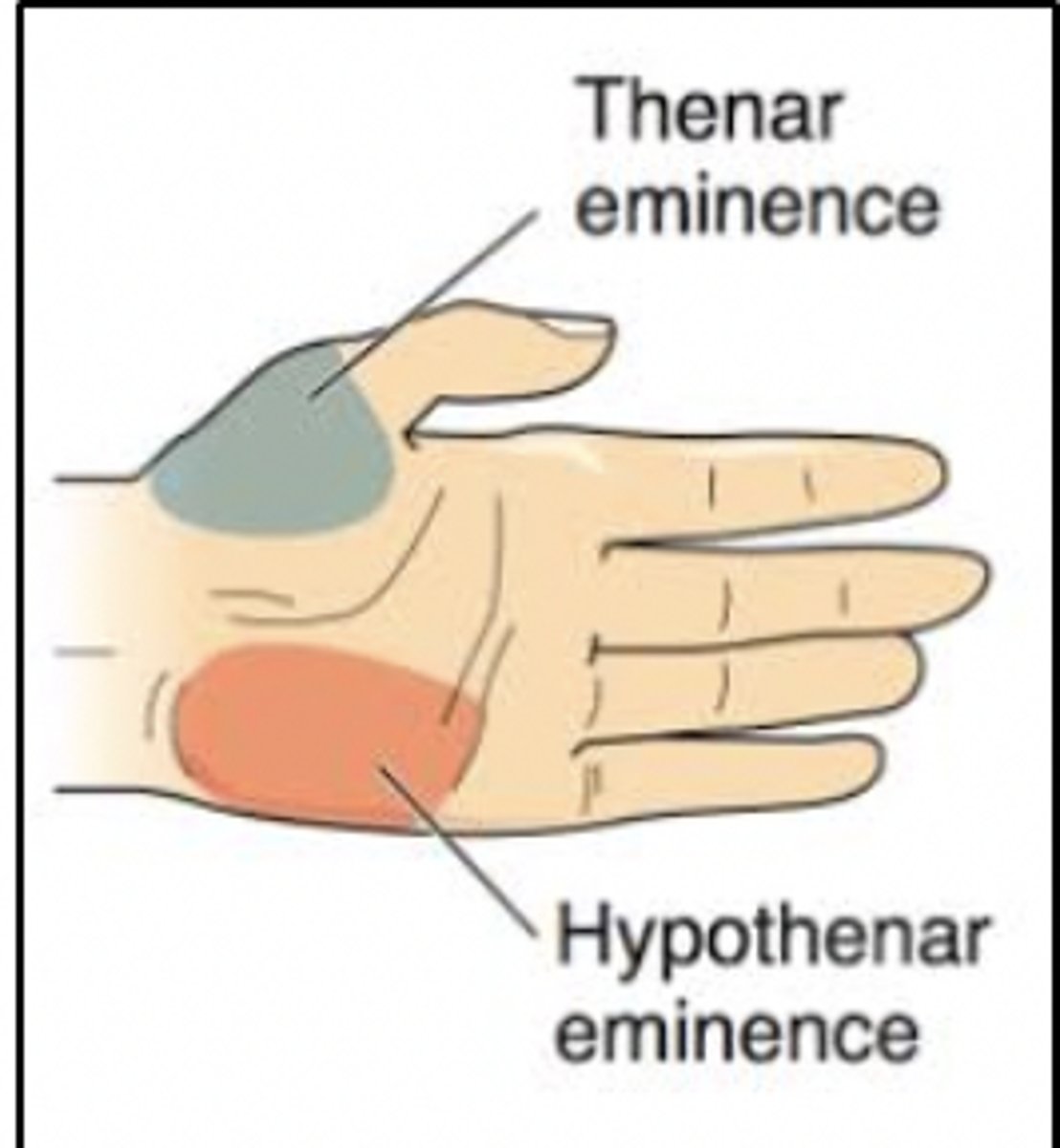 <p>Rationale</p><p>1. Carpal tunnel syndrome is a result of entrapment of the median nerve, which innervates the thenar eminence.</p><p>2. The C8 nerve root innervates the hypothenar eminence. Injury to the C8 nerve root will cause paresthesia in the hypothenar eminence</p><p>3. De Quervain tenosynovitis affects the first dorsal compartment. It would not cause paresthesia in the hypothenar eminence. (Dutton, pp. 847-848)</p><p>4. Pronator teres syndrome affects the median nerve. It would cause paresthesia in the thenar eminence.</p>
