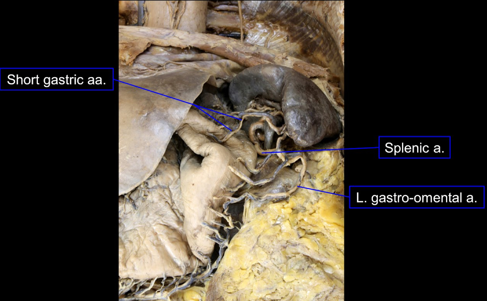 <ul><li><p>small pancreatic branches</p></li><li><p>short gastric arteries</p></li><li><p>left gastroomental artery</p></li></ul><p></p>