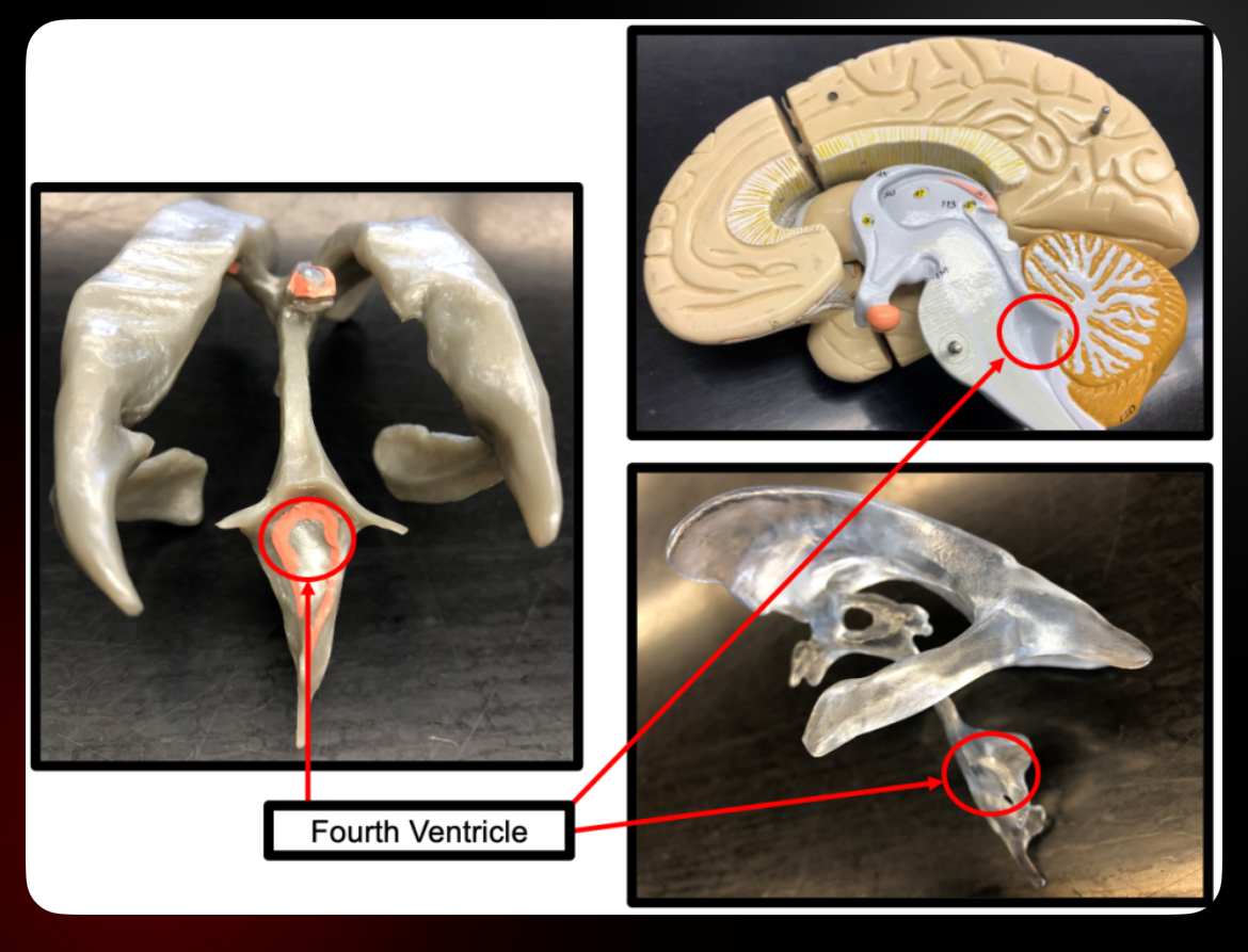 <p>Fourth Ventricle</p>