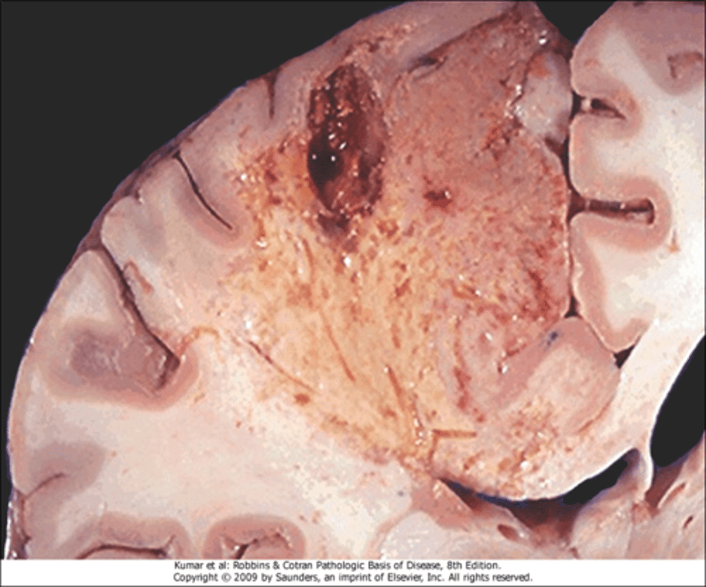 <p>liquefactive necrosis</p>
