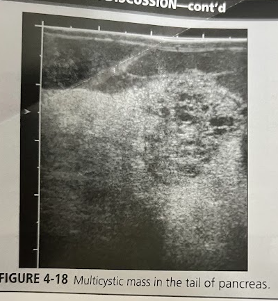 <p>A 50 year old woman undergoes a sonogram for nonspecific abd. pain and a feeling of general malaise. While scanning the upper abd., the sonographer notices a multicystic mass in the tail of the pancreas. The pt denies any hx of smoking or alcohol abuse. Lab tests are unremarkable. A CT scan was performed and confirmed that the multicystic lesion was arising from the pancreas. Discuss the diagnostic possibilities.</p>