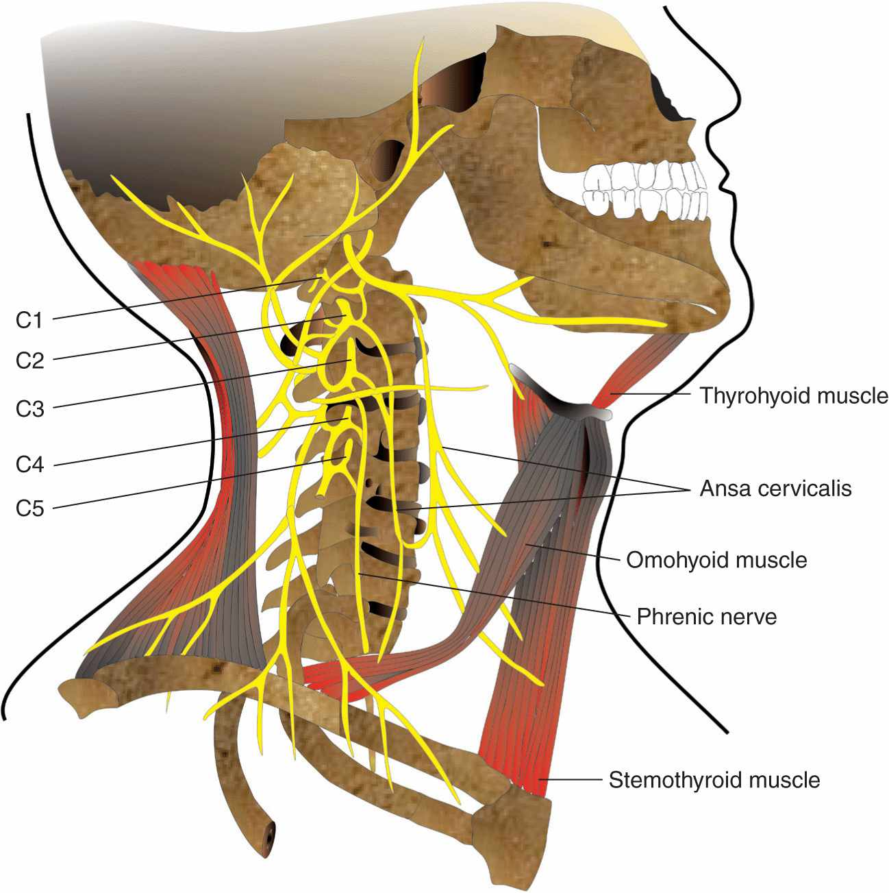<p>T/F The cervical plexus of nerves</p><p><strong>T -</strong> A. supplies motor branches to the infrahyoid muscles</p><ul><li><p>via ansa cervicalis (loop formed from C1, C2, C3)</p></li></ul><p><strong>F -</strong> B. supplies motor branches to the muscles of the suboccipital triangle</p><ul><li><p><strong>suboccipital triangle</strong> is mainly innervated by the <strong><u>suboccipital nerve (C1)</u></strong>, which is a <strong>motor branch</strong> of the <strong>dorsal ramus of C1</strong> (not part of the cervical plexus)</p></li></ul><p><strong>T -</strong> C. supplies branches to the trapezius muscle</p><ul><li><p>via the <strong>accessory nerve</strong></p></li></ul><p><strong>T -</strong> D. supplies sensory branches to the diaphragm</p><ul><li><p><strong>phrenic nerve</strong> (arising from <strong>C3, C4, and C5</strong> of the cervical plexus)</p></li></ul><p><strong>F -</strong> E. supplies sensory branches to the front of the scalp.</p><ul><li><p><strong>anterior scalp</strong> is primarily innervated by branches from the <strong><u>trigeminal nerve (CN V)</u></strong></p></li></ul><p></p>