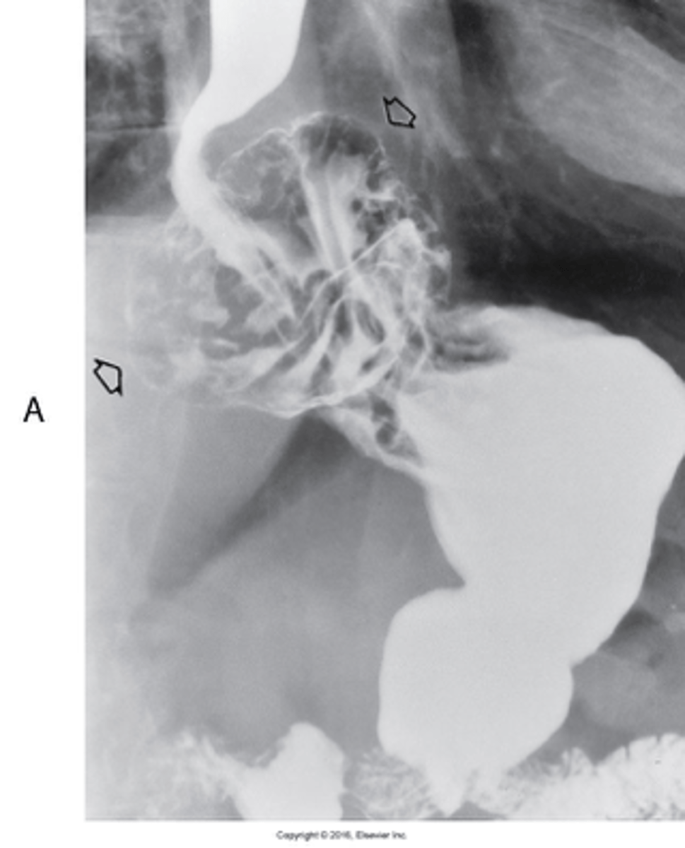 <p>What is a hiatal hernia?</p>