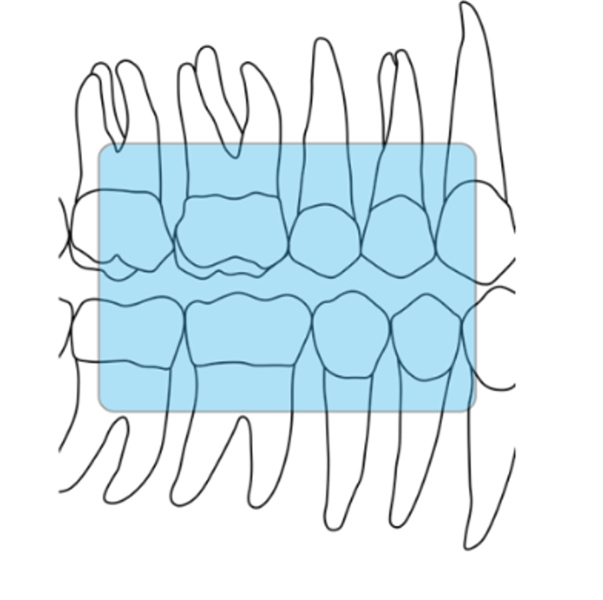 <p>size 2</p><p>distal of canine, proximal surfaces of 1st and 2nd premolars, and 1st molar</p>