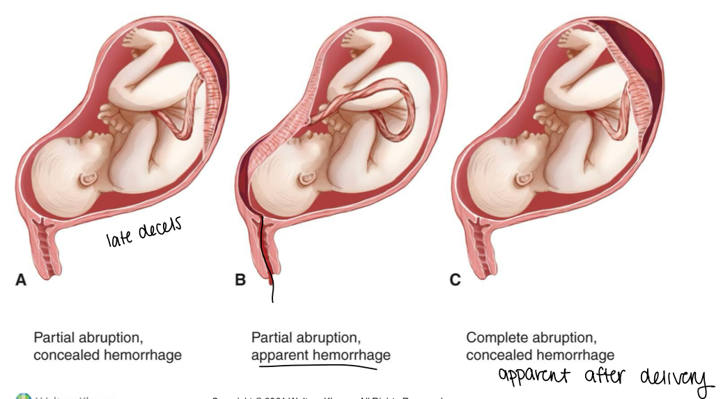 <p>separation of the placenta after the 20th week gestation leading to compromised fetal blood supply </p><p>Can be partial or full (full = dead baby)</p>