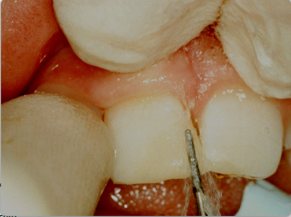 <p>excess is trimmed with a water jet and fine diamond burs to recontour the restoration&nbsp;</p><p>better done with the rubber dam removed - gives access to all the tooth tissue&nbsp;</p>