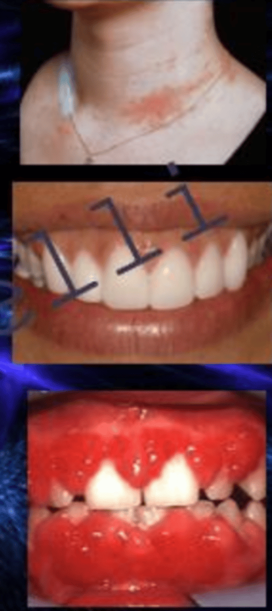 <p>nickel allergies are more common in _______ and can be caused from chronic exposure through jewelry and can be quite severe</p>