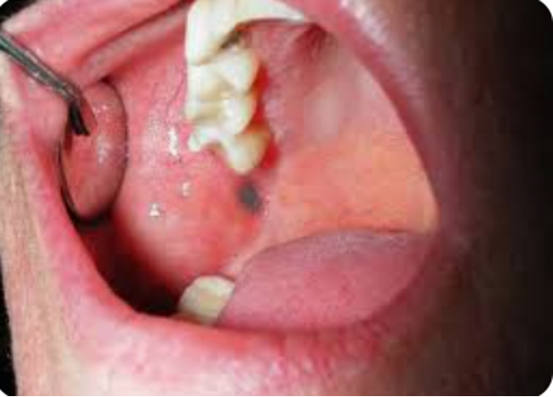 <p>benign, painless, common discoloration in th mouth that occurs when amalgam (dental filling material) is embedded into oral tissues during dental procedures </p>