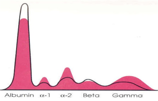 <p>under production of albumin</p>