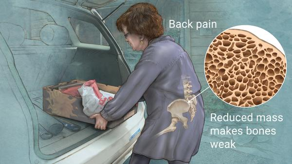 <p><strong>Which of the following clients on a medical unit of a hospital is most likely to be experiencing health problems that may be attributable to kidney disease?</strong></p><p>A) An 81-year-old female client with osteoporosis and anemia</p><p>B) A 77-year-old client with urinary retention due to benign prostatic hyperplasia (BPH)</p><p>C) A 55-year-old woman with a recent stroke secondary to long-standing hypertension</p><p>D) A 60-year-old man with a systemic fungal infection requiring intravenous antibiotics.</p>