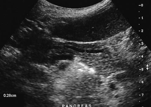 <p>a patient presents with a history of elevated liver function tests. An anechoic tubular structure is identified in the body of the pancreas. This structure most likely represents the</p>