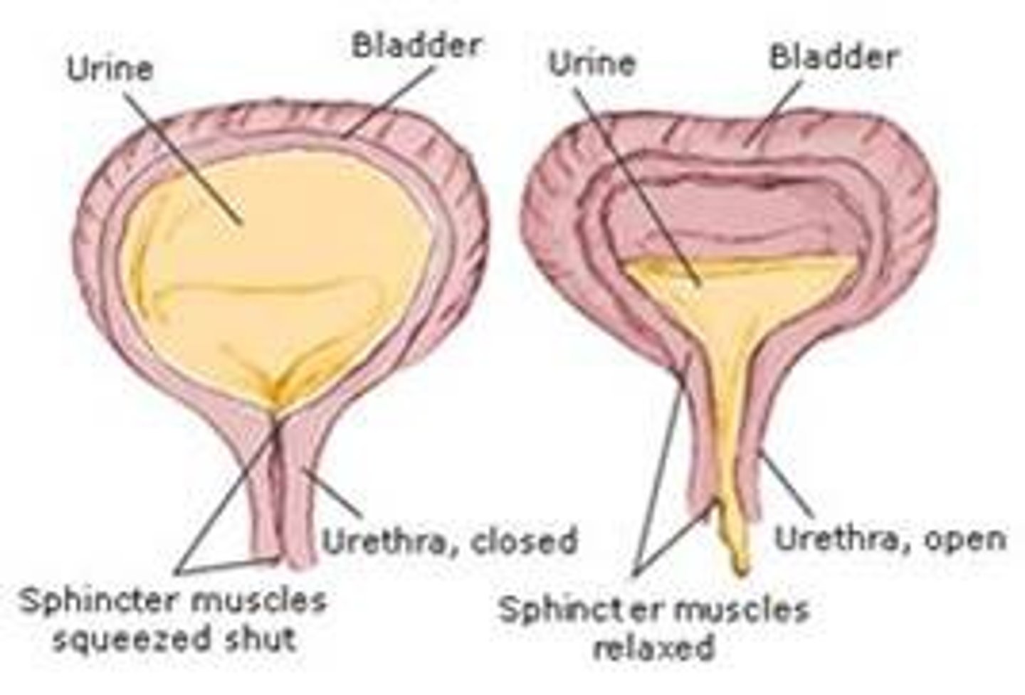 <p>What: The inability of the bladder to store urine (brain cannot halt urination anymore)</p><p>Cause: Spinal injury above T12</p><p>S+S: Involuntary urination</p>