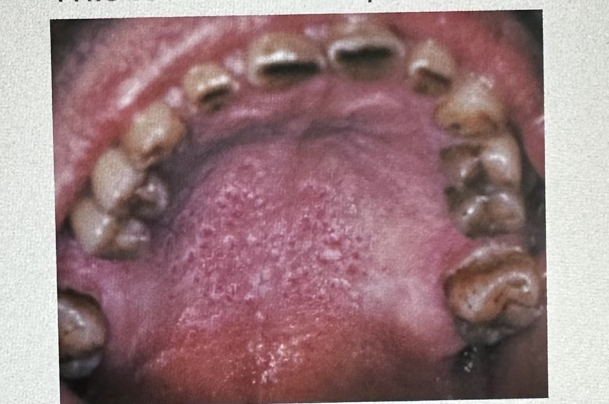 <p><span>This lesion on the palate is typically associated with heavy pipe and cigar smoking and is called:</span><br><br><span>A. tobacco pouch keratosis</span><br><span>B. necrotizing sialometaplasia</span><br><span>C. nicotine stomatitis</span><br><span>D. frictional keratosis</span></p>