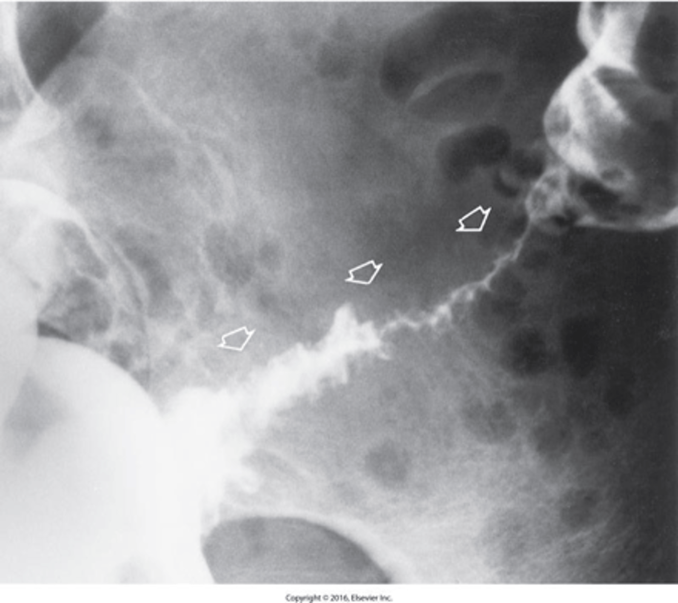<p>What is diverticulitis?</p>
