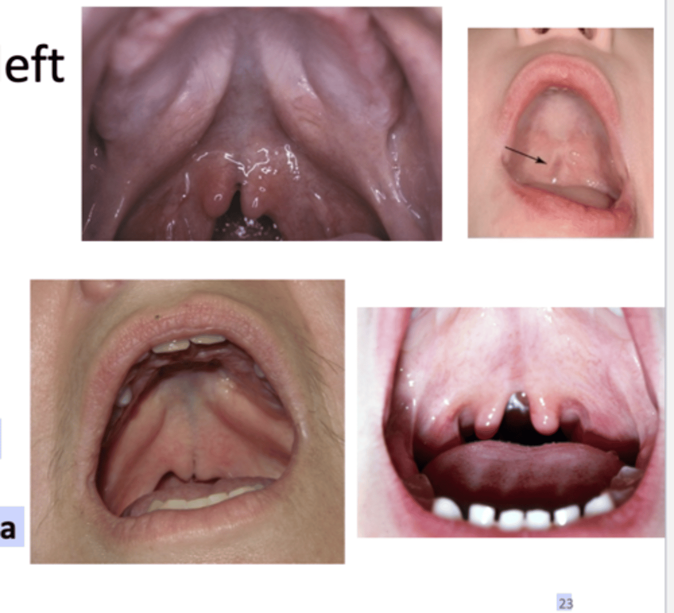 <p>How is submucous palatal cleft appear as? how is it best identified? what is it asscoiated with? </p>